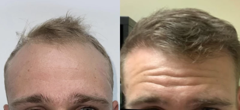 Patient 606 Hair Transplant Before and After