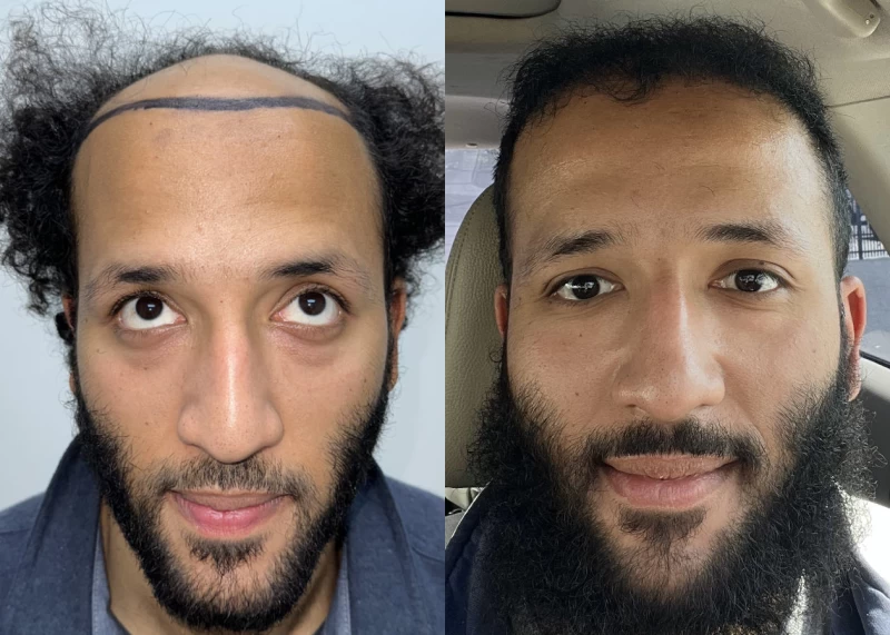 Patient 607 Hair Transplant Before and After