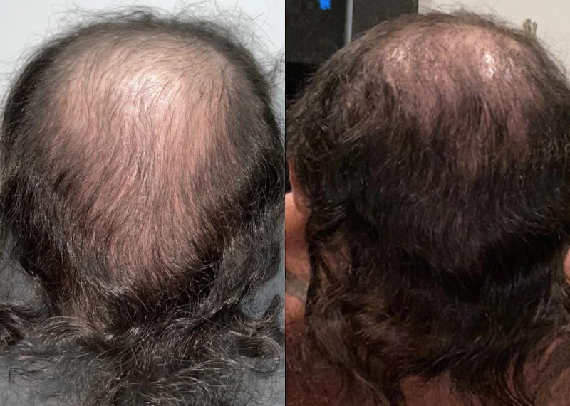 Patient 608 Hair Transplant Before and After
