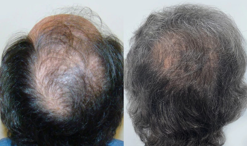 Patient p609 hair transplant before and after crown view