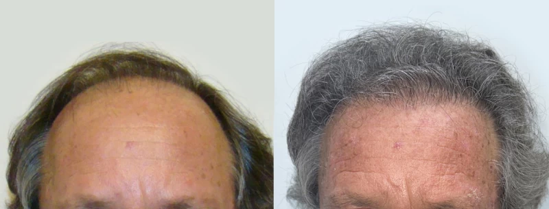 Patient 609 Hair Transplant Before and After