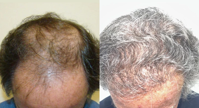 Patient p609 hair transplant before and after tilt view
