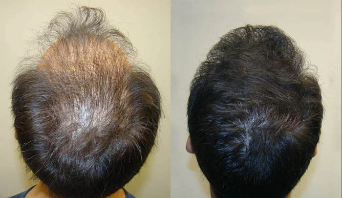 Patient p60 hair transplant before and after crown view