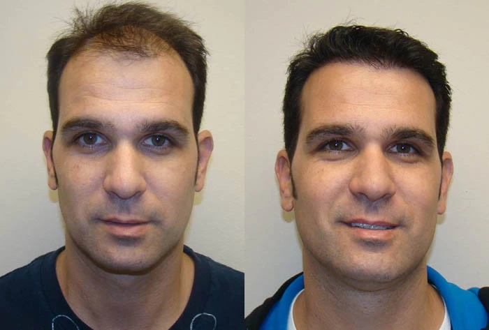 Avi Hair Transplant Before and After