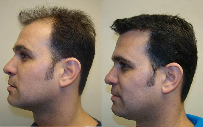 Patient p60 hair transplant before and after left view