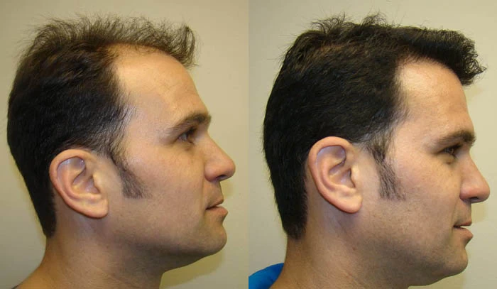 Patient p60 hair transplant before and after right view