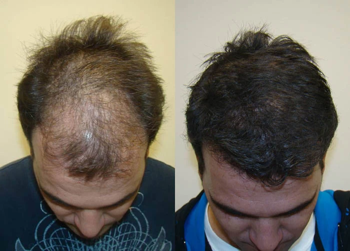 Patient p60 hair transplant before and after tilt view