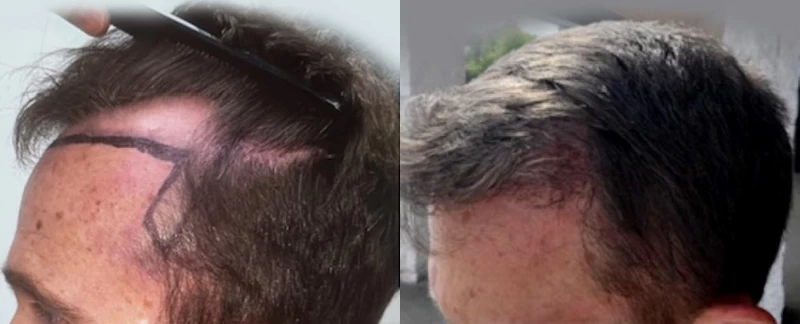 Patient p610 hair transplant before and after left view