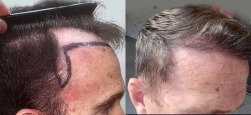 Patient p610 hair transplant before and after right view