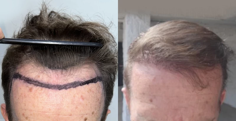 Patient 610 Hair Transplant Before and After