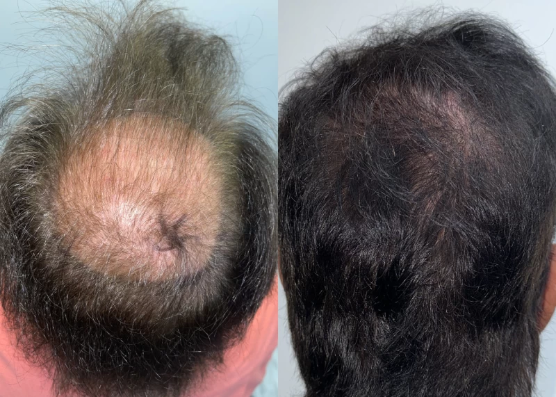 Patient p611 hair transplant before and after crown view