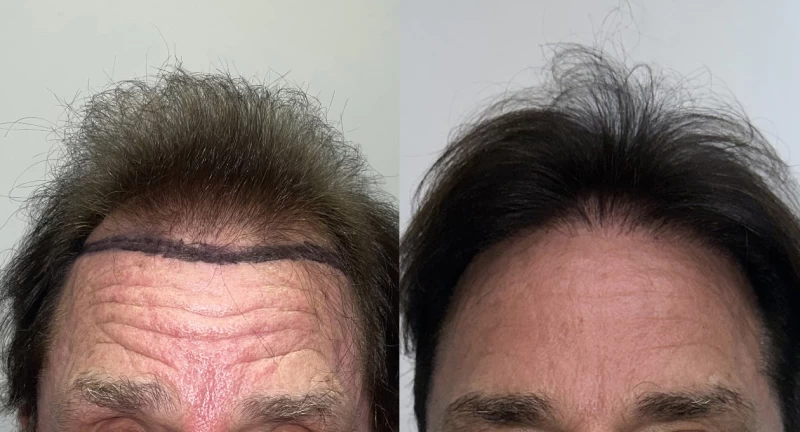 Patient 611 Hair Transplant Before and After
