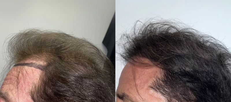 Patient p611 hair transplant before and after left view