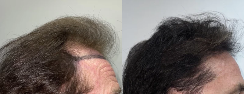 Patient p611 hair transplant before and after right view