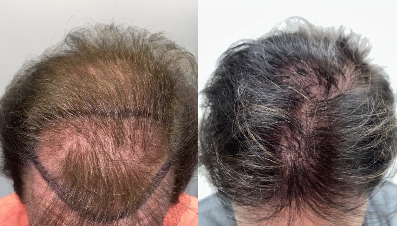 Patient p611 hair transplant before and after tilt view