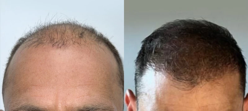 Patient 612 Hair Transplant Before and After
