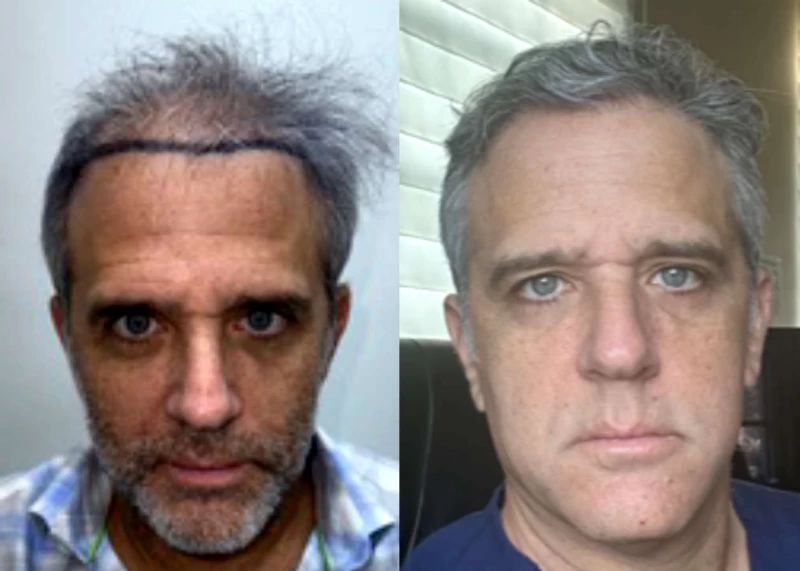 Patient 613 Hair Transplant Before and After