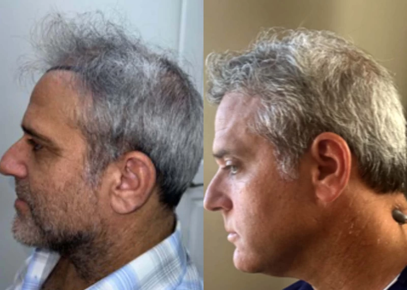 Patient p613 hair transplant before and after left view