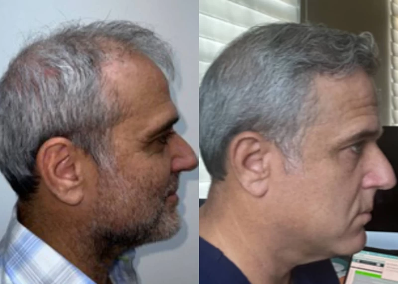 Patient p613 hair transplant before and after right view