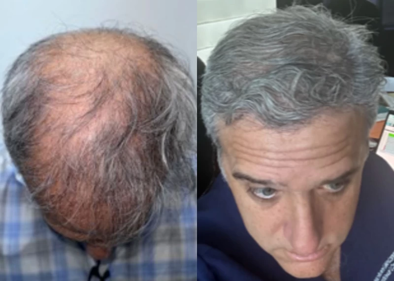 Patient p613 hair transplant before and after tilt view
