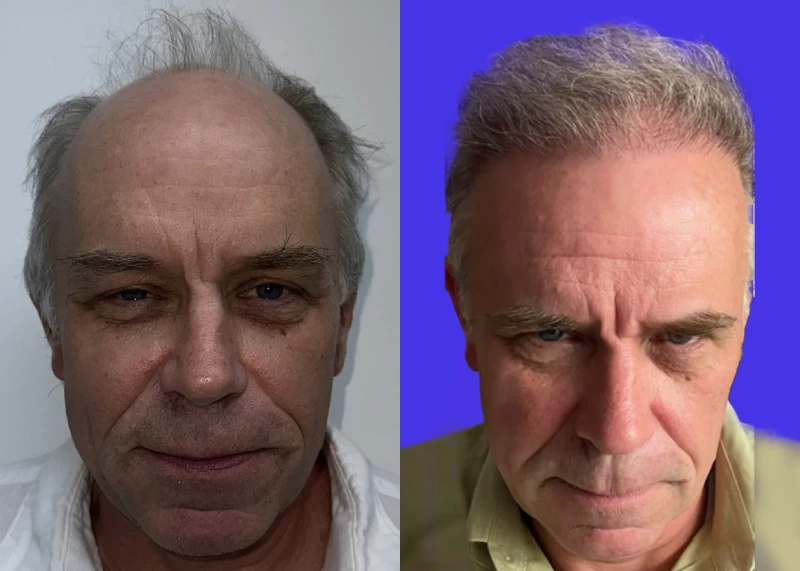 Patient 614 Hair Transplant Before and After