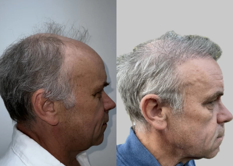 Patient p614 hair transplant before and after right view