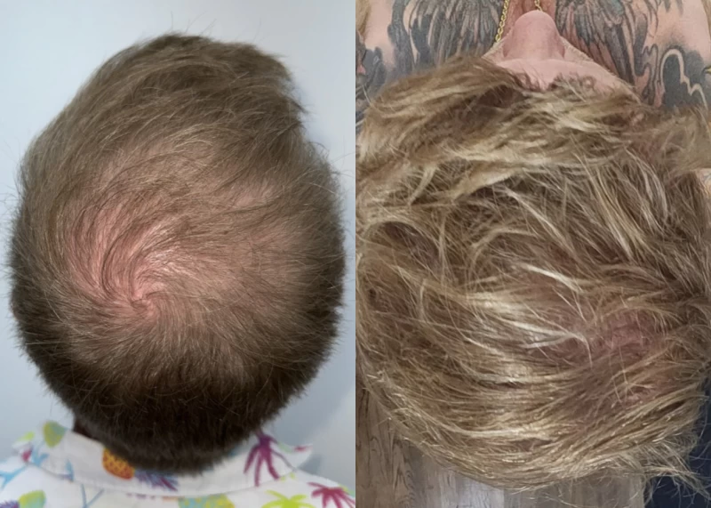 Patient p615 hair transplant before and after crown view