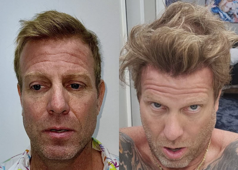 Patient 615 Hair Transplant Before and After