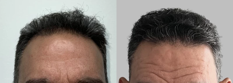 Patient 616 Hair Transplant Before and After