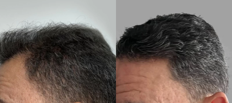 Patient p616 hair transplant before and after left view