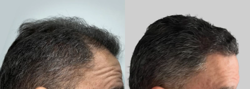 Patient p616 hair transplant before and after right view