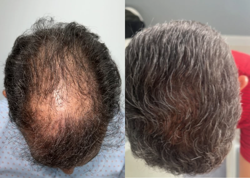 Patient p616 hair transplant before and after tilt view