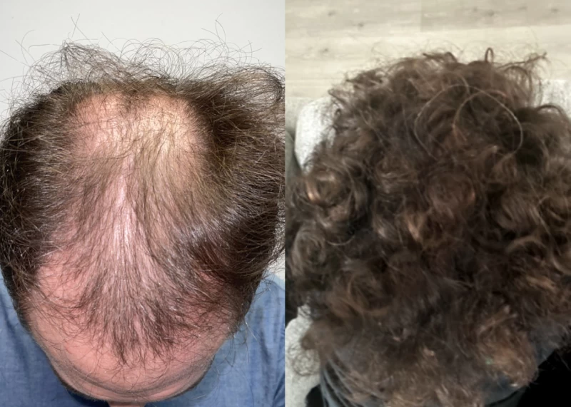 Patient p617 hair transplant before and after tilt view