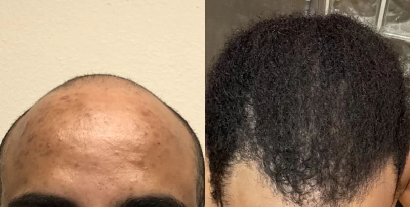 Patient 618 Hair Transplant Before and After