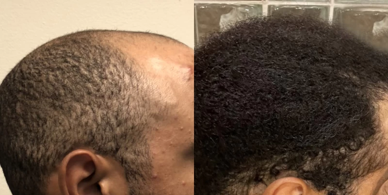 Patient p618 hair transplant before and after right view