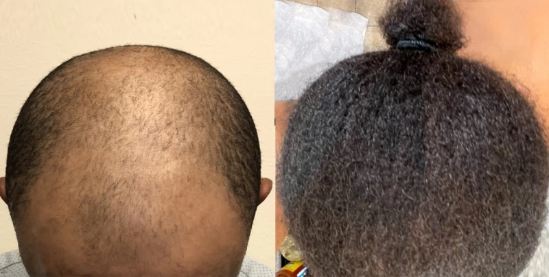 Patient p618 hair transplant before and after tilt view