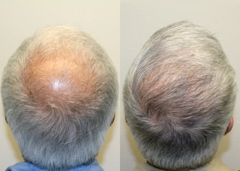 Patient p619 hair transplant before and after crown view