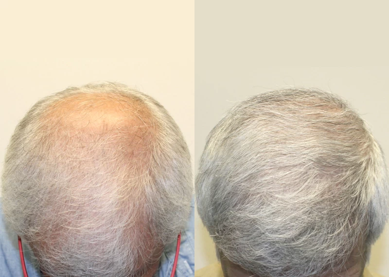 Patient 619 Hair Transplant Before and After