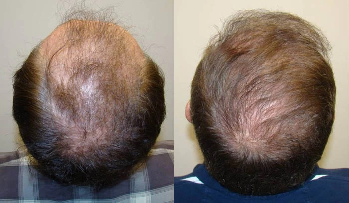 Patient p61 hair transplant before and after crown view