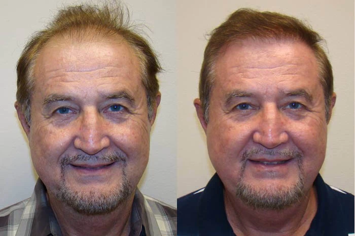 Stewart Hair Transplant Before and After