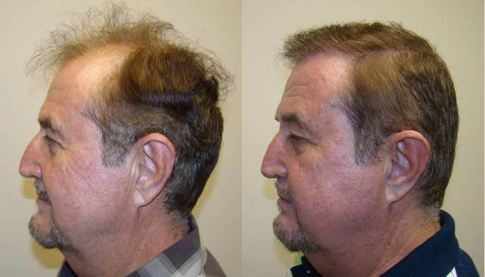 Patient p61 hair transplant before and after left view
