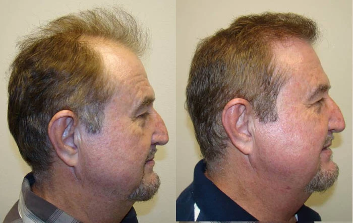 Patient p61 hair transplant before and after right view