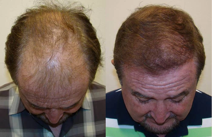 Patient p61 hair transplant before and after tilt view