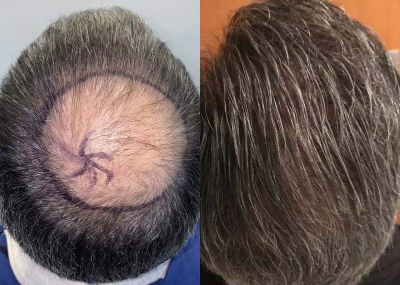 Patient p620 hair transplant before and after crown view