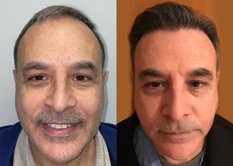 Patient 620 Hair Transplant Before and After