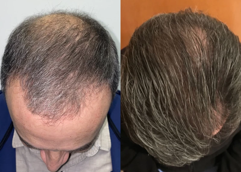 Patient p620 hair transplant before and after tilt view