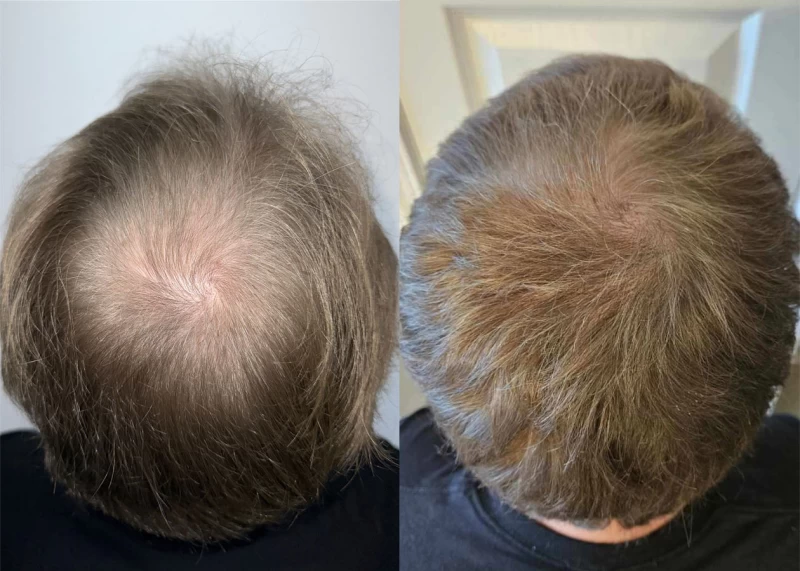 Patient p621 hair transplant before and after crown view