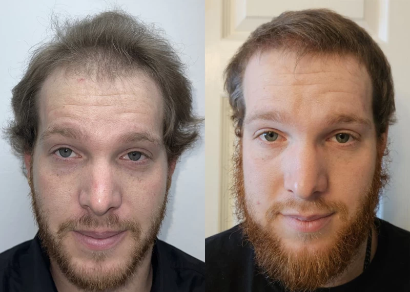 Patient 621 Hair Transplant Before and After