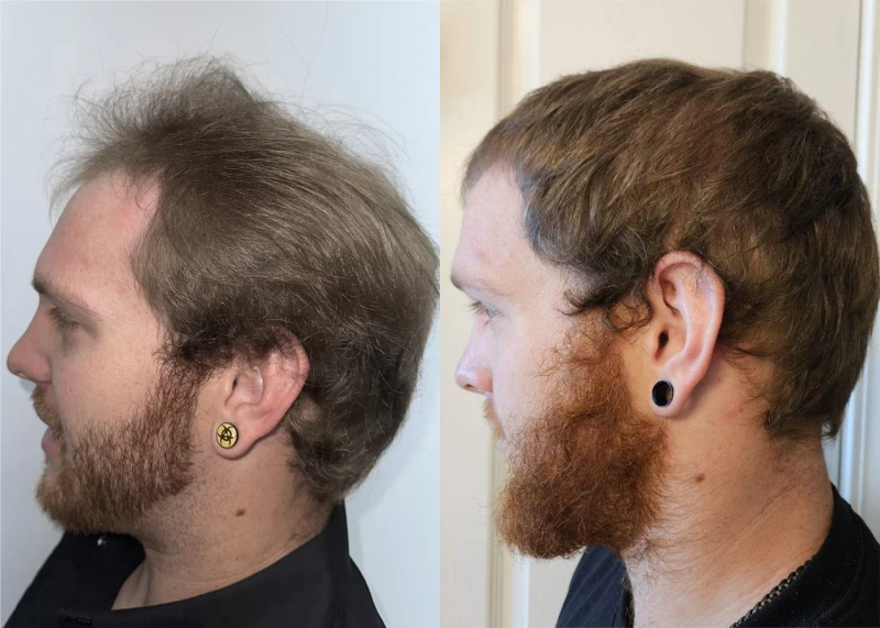 Patient p621 hair transplant before and after left view