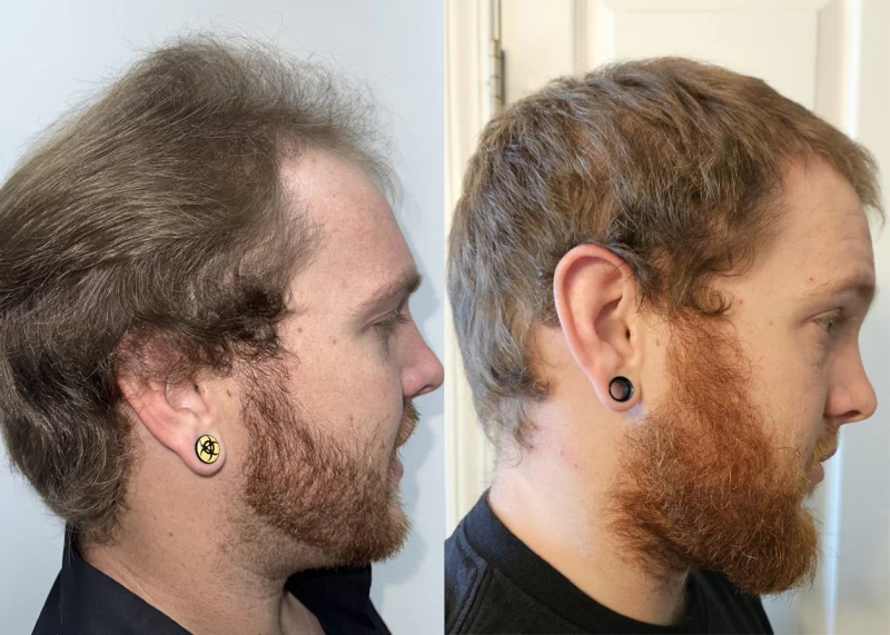 Patient p621 hair transplant before and after right view